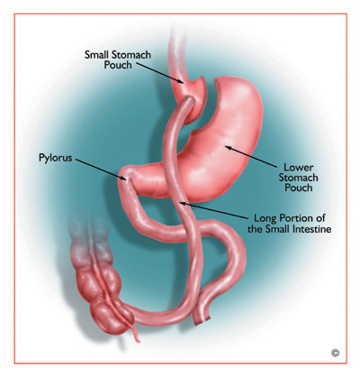 Extended (Distal) Roux-en-Y Gastric Bypass